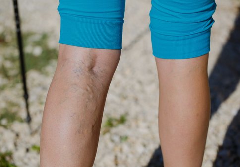 Vein Therapy