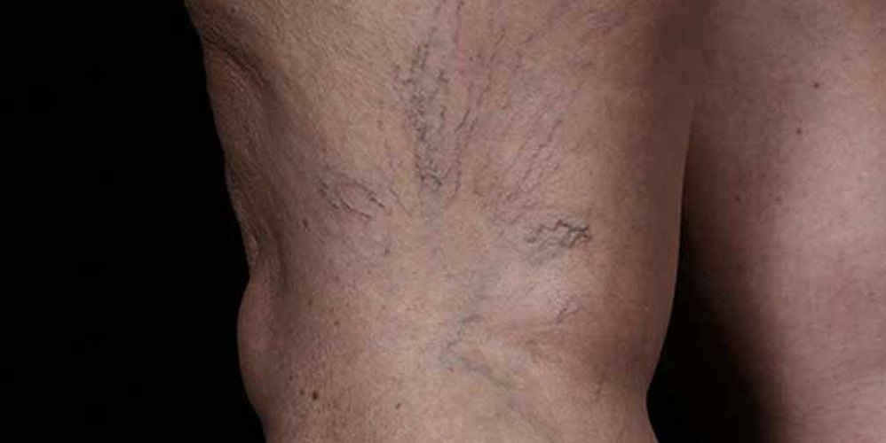 Laser Vein Therapy: Before