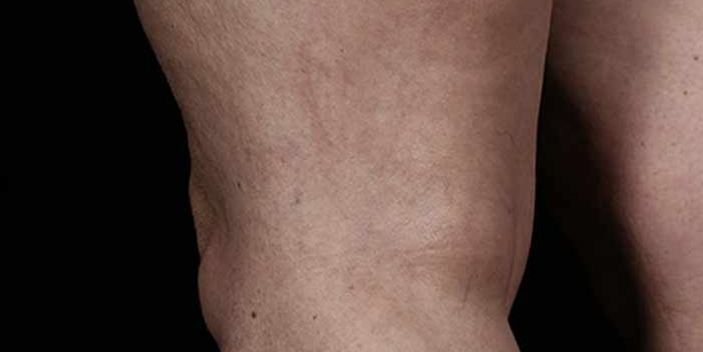 Laser Vein Therapy: After 2 Treatments