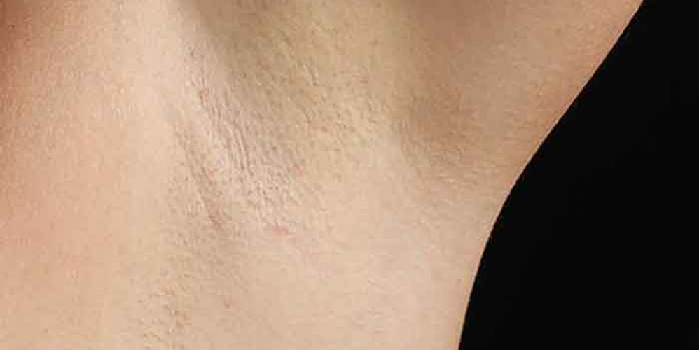 Hair Removal Solutions: After
