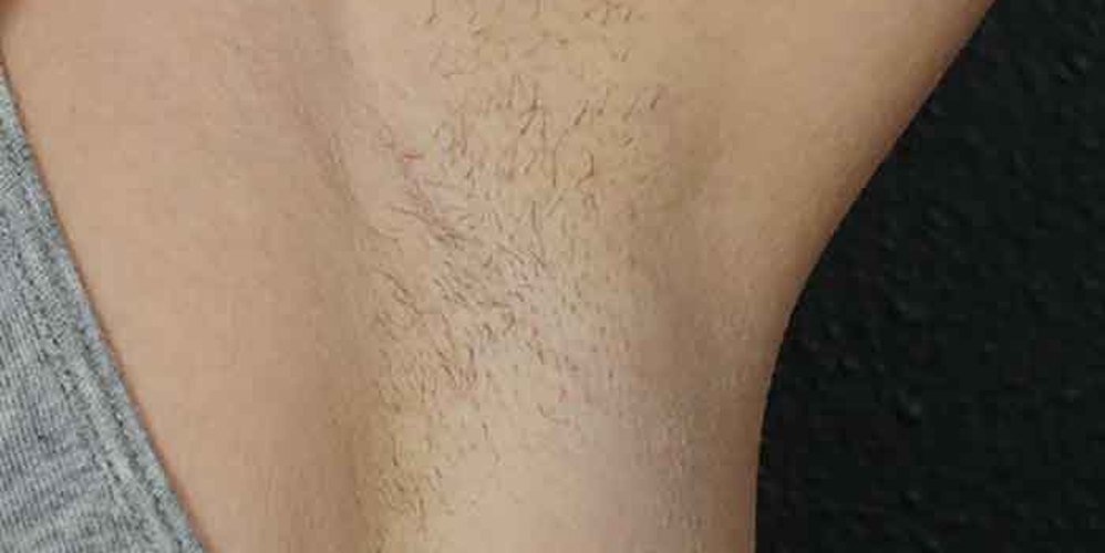 Hair Removal Solutions: Before